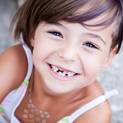 Silver Diamine Fluoride